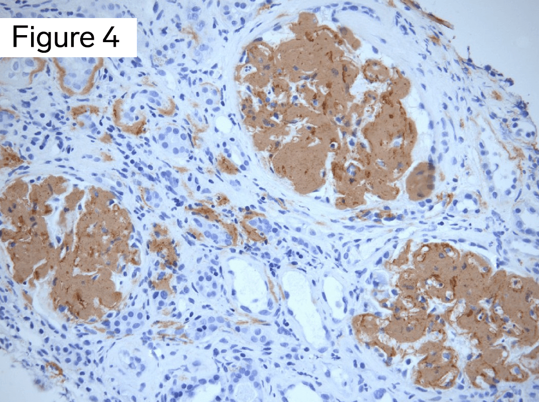 Amyloidosis, deposits stain positive on immunohistochemical stain for serum amyloid A protein
