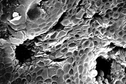 Squamoid-Appearing Surface Urothelial Cells