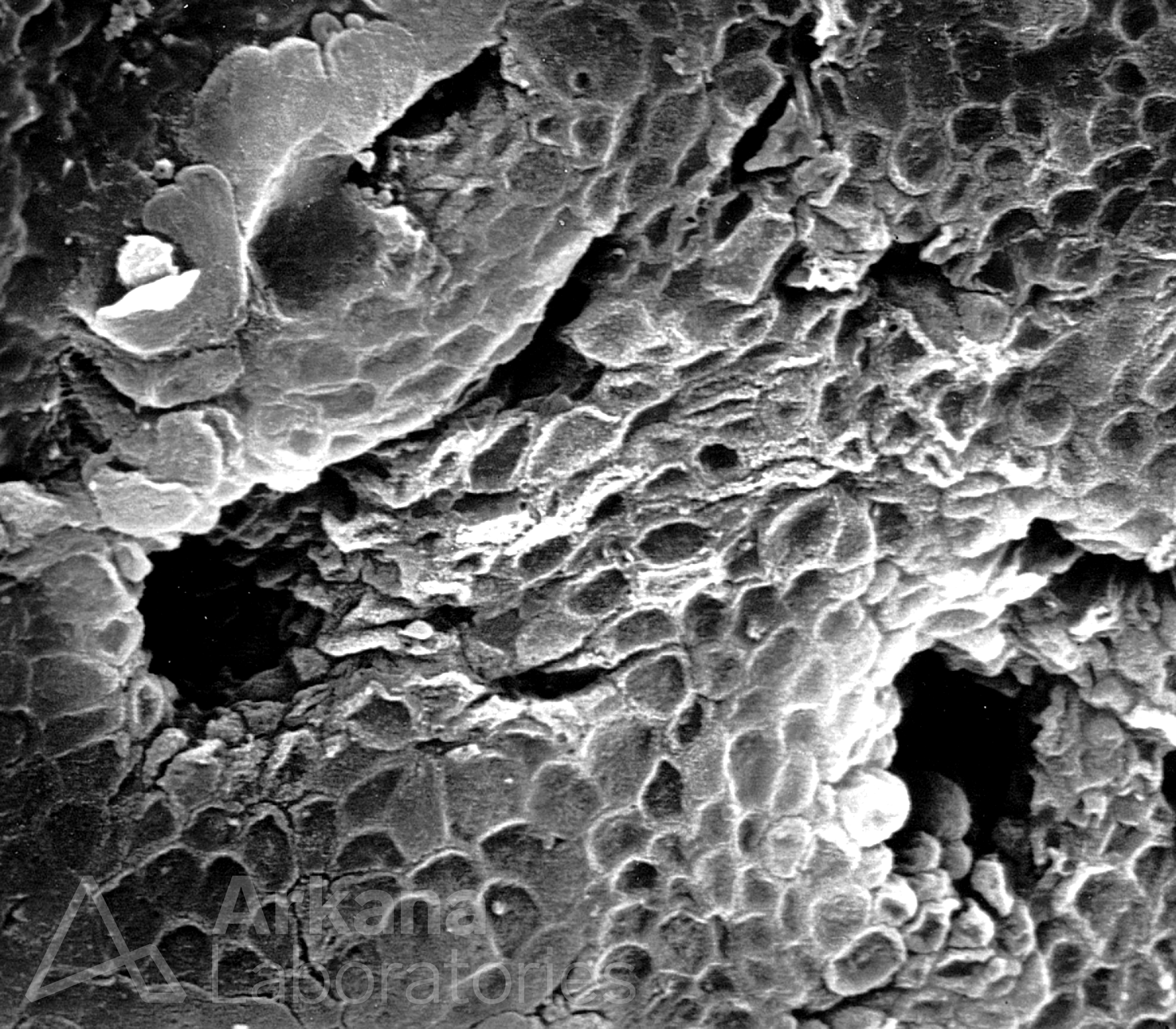 Squamoid-Appearing Surface Urothelial Cells