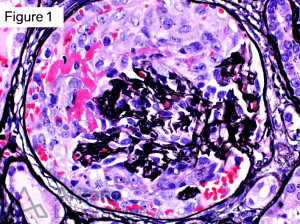 glomerular crescent