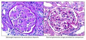 Amyloidosis