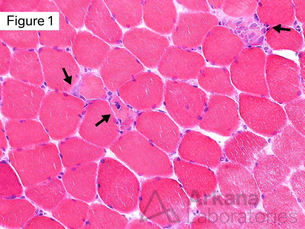 Necrotic Myofibers