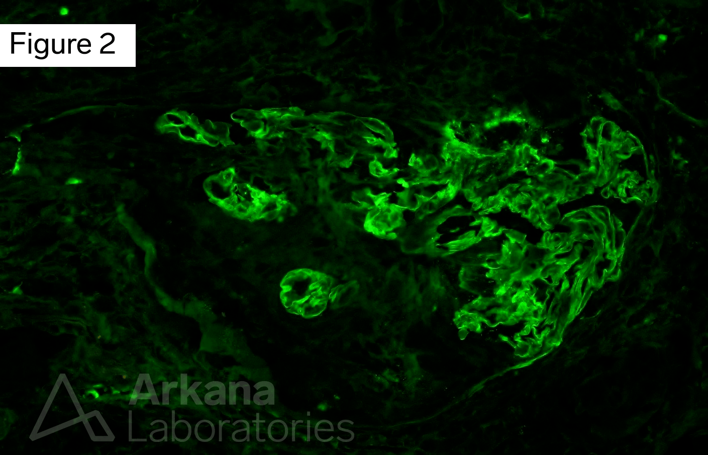 lobal linear capillary wall staining for IgG