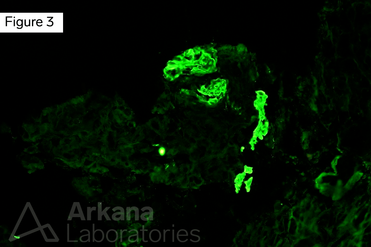 fibrinogen stain highlights fibrin in areas of fibrinoid necrosis