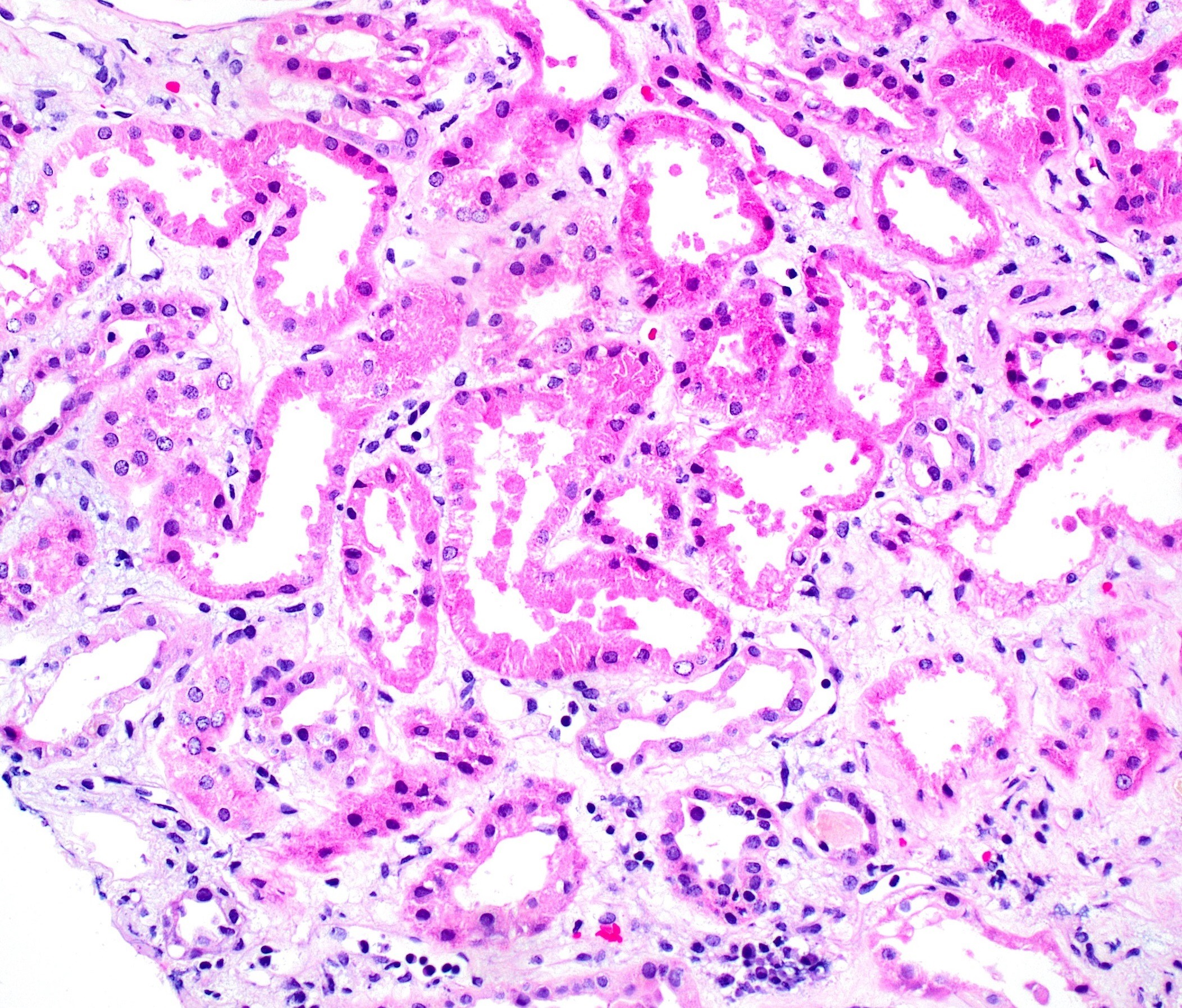 methotrexate-induced crystalline nephropathy