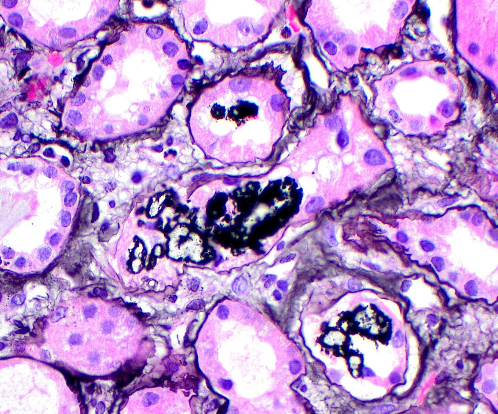 methotrexate-induced crystalline nephropathy