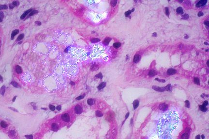 methotrexate-induced crystalline nephropathy