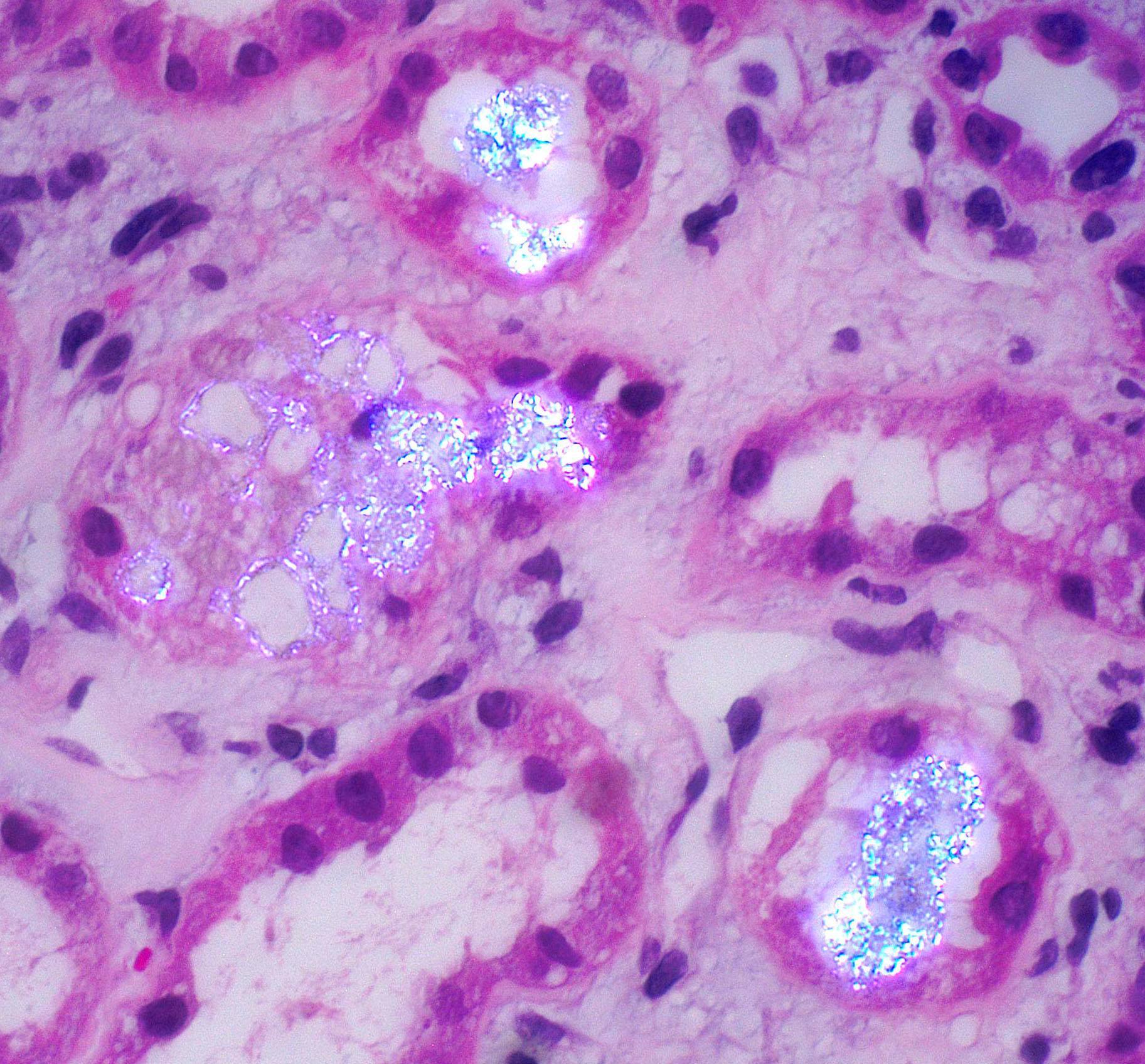 methotrexate-induced crystalline nephropathy