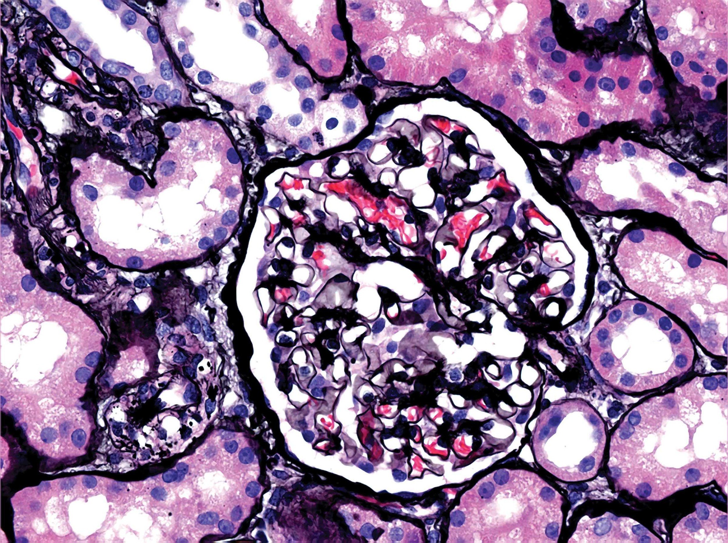 Renal pathology- image of glomerulus from renal biopsy
