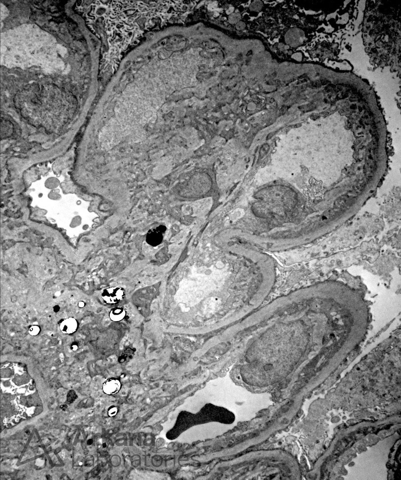 Hepatic Glomerulosclerosis