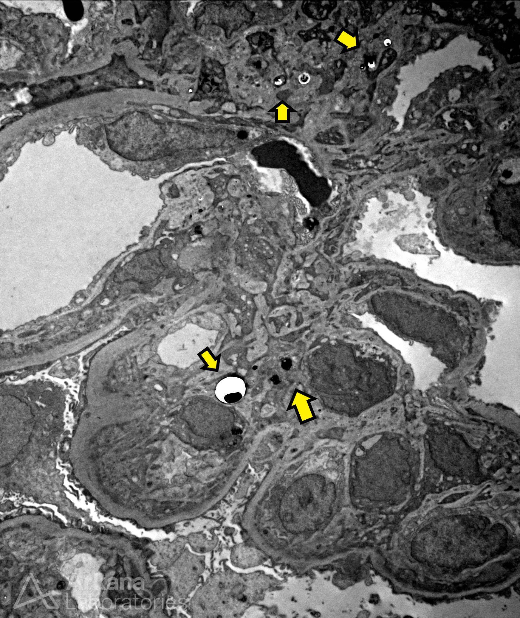 Hepatic Glomerulosclerosis