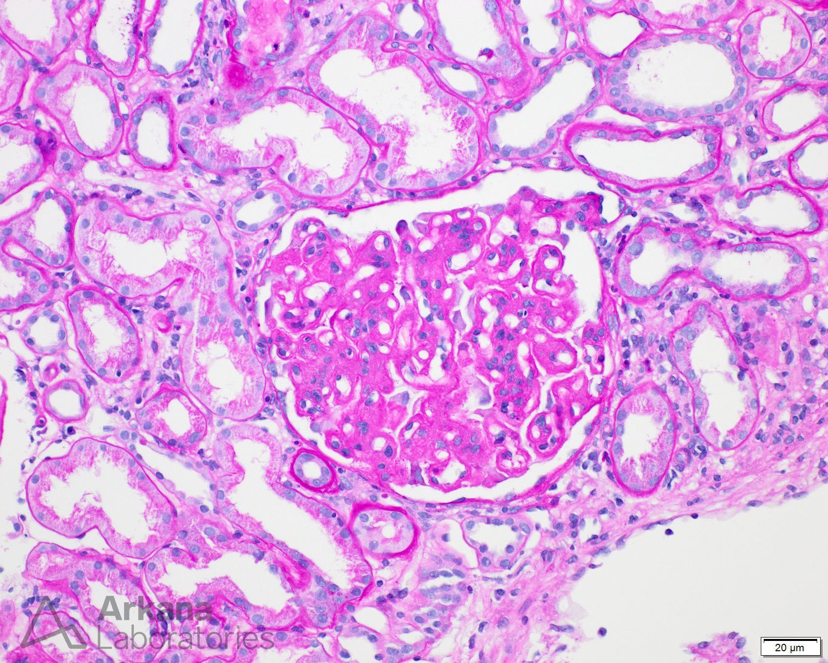 Mesangial and Endocapillary Hypercellularity