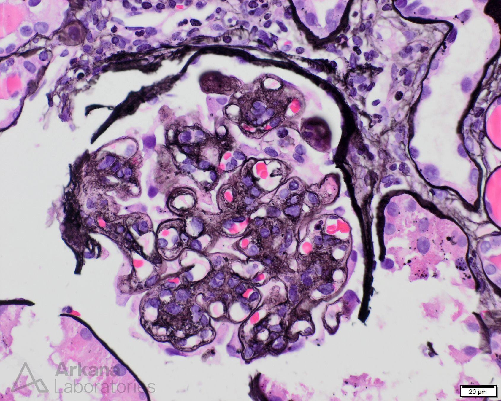 Hepatic Glomerulosclerosis