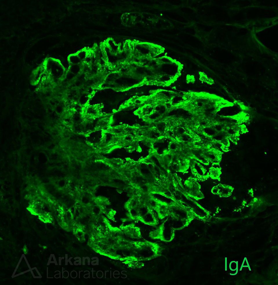 Hepatic Glomerulosclerosis