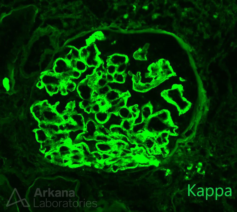 Hepatic Glomerulosclerosis