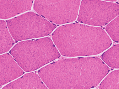 diagnostic image of nerve and muscle biopsy sent to arkana laboratories stained pink