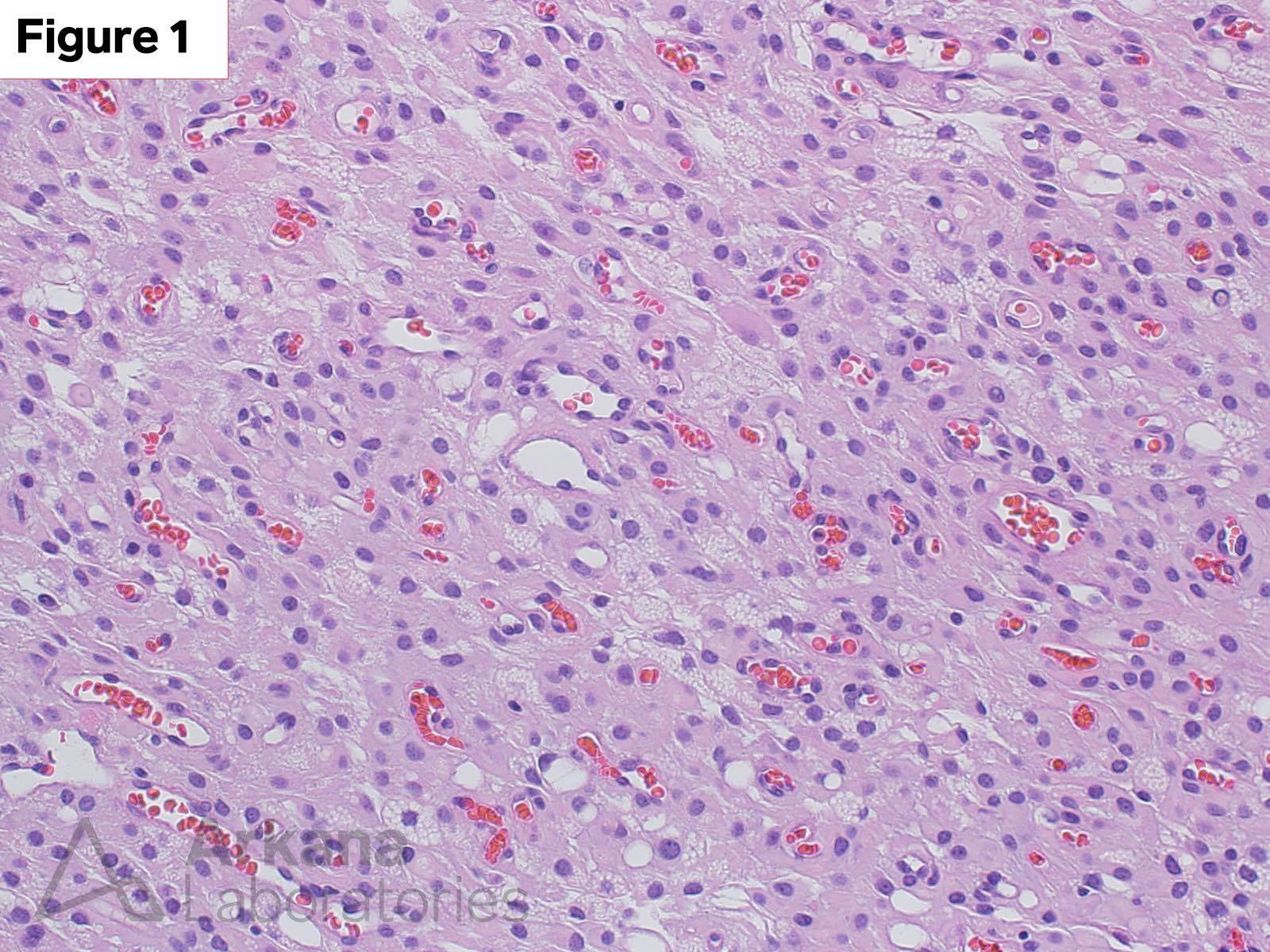 Meningioma