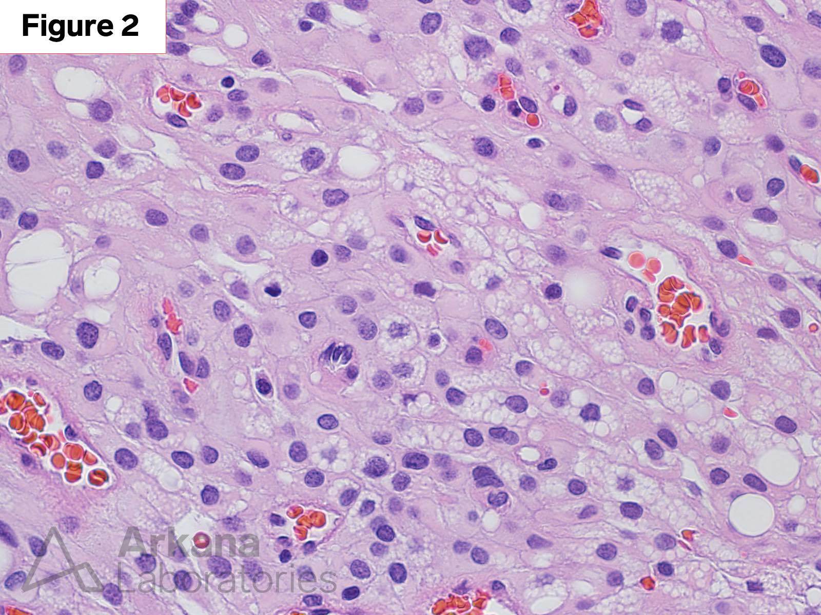 Meningioma