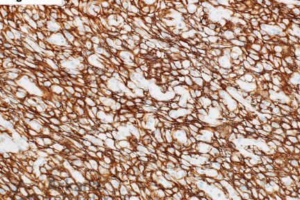 Meningioma