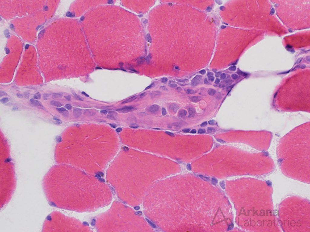 Intravascular lymphoma