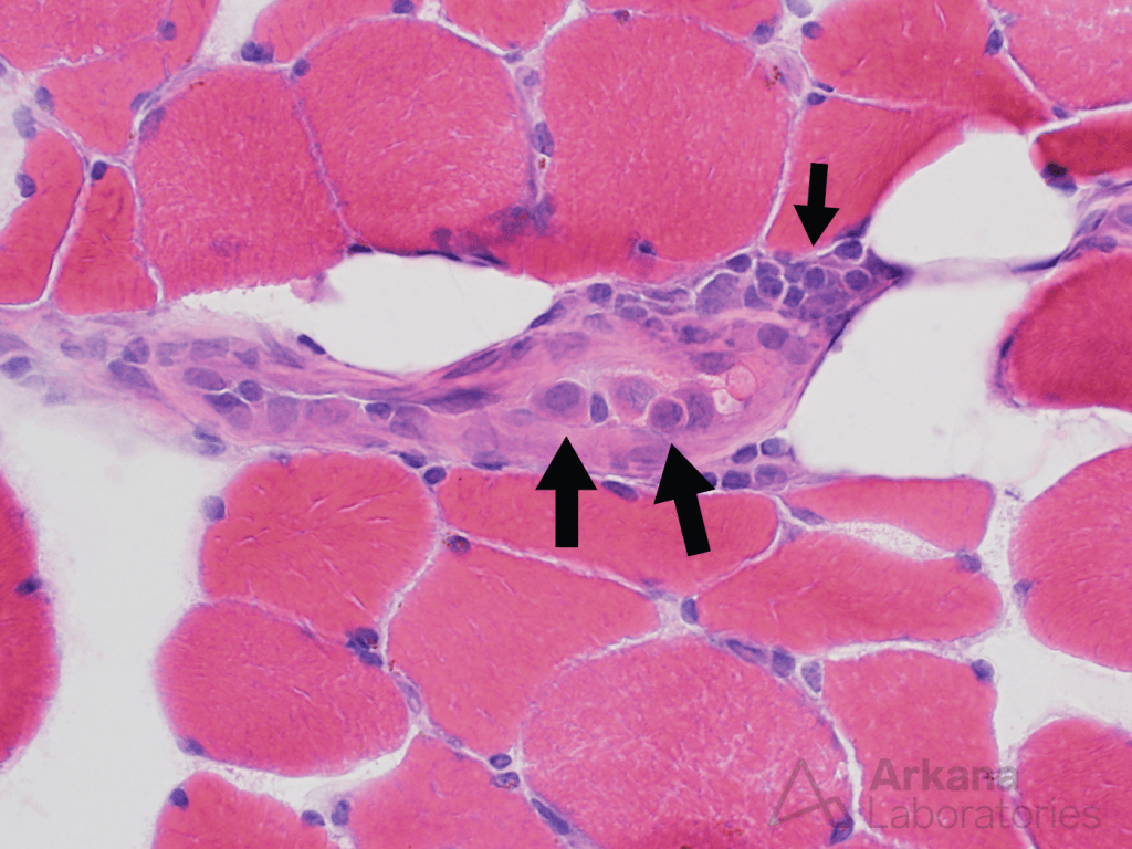 Intravascular lymphoma