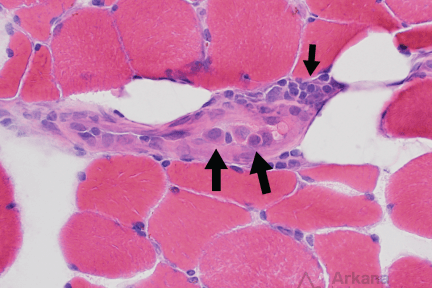 Intravascular lymphoma