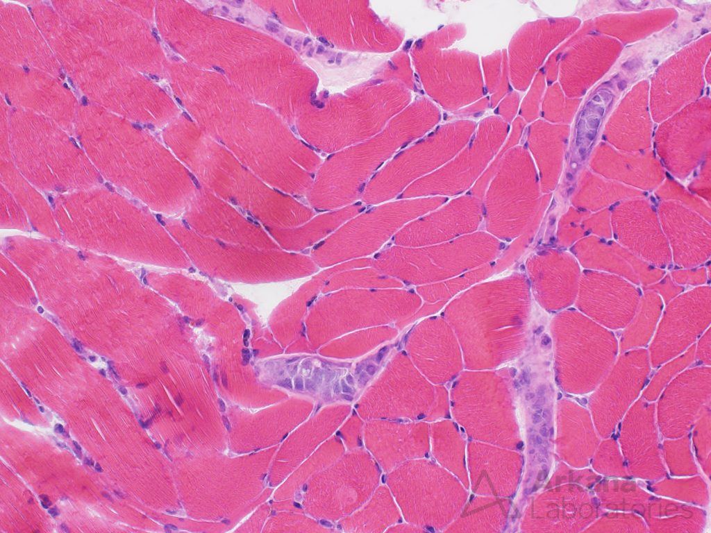 Intravascular lymphoma