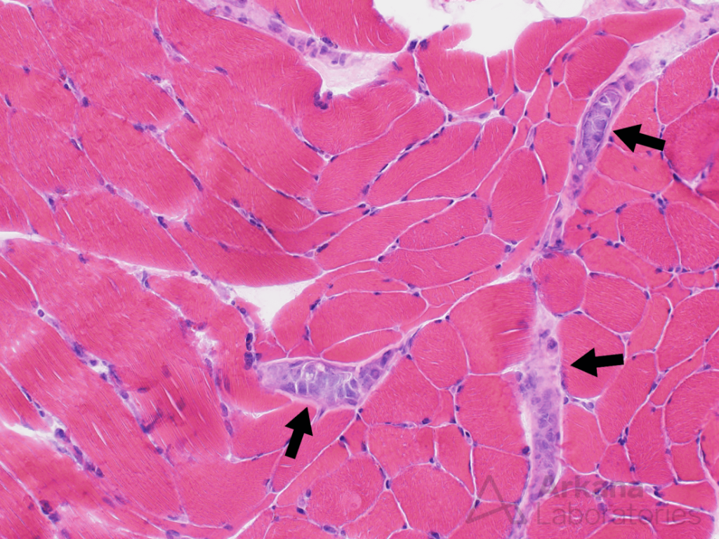 Intravascular lymphoma