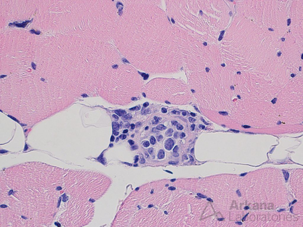 Intravascular lymphoma