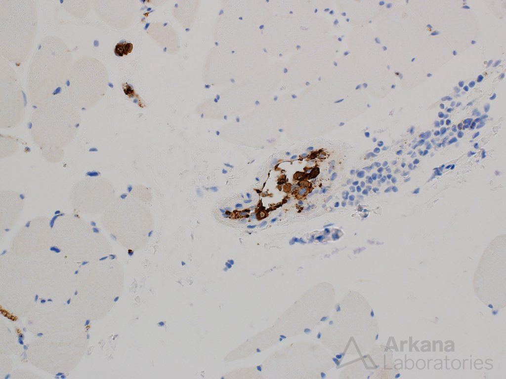 Intravascular lymphoma