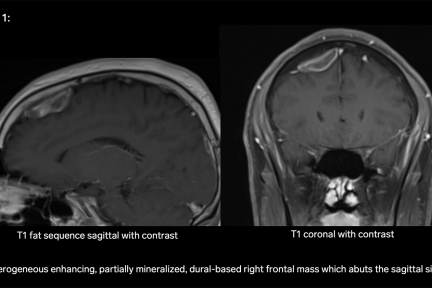 Dural Mass