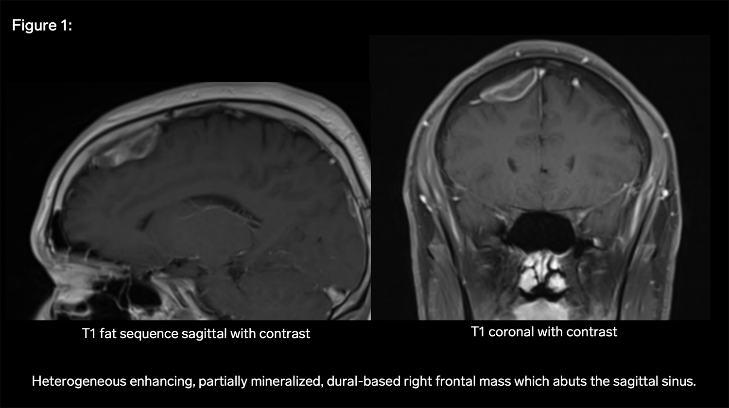 Dural Mass