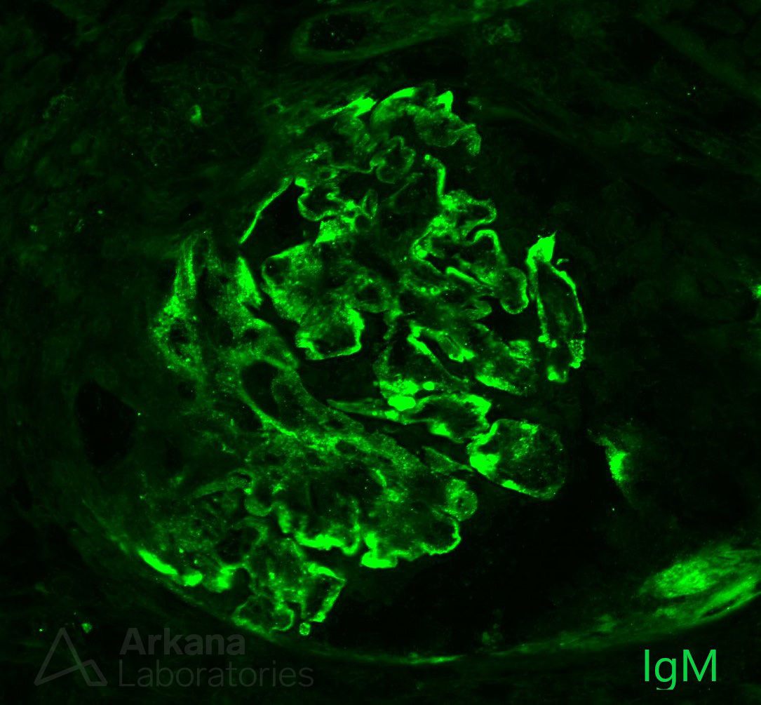 Hepatic Glomerulosclerosis