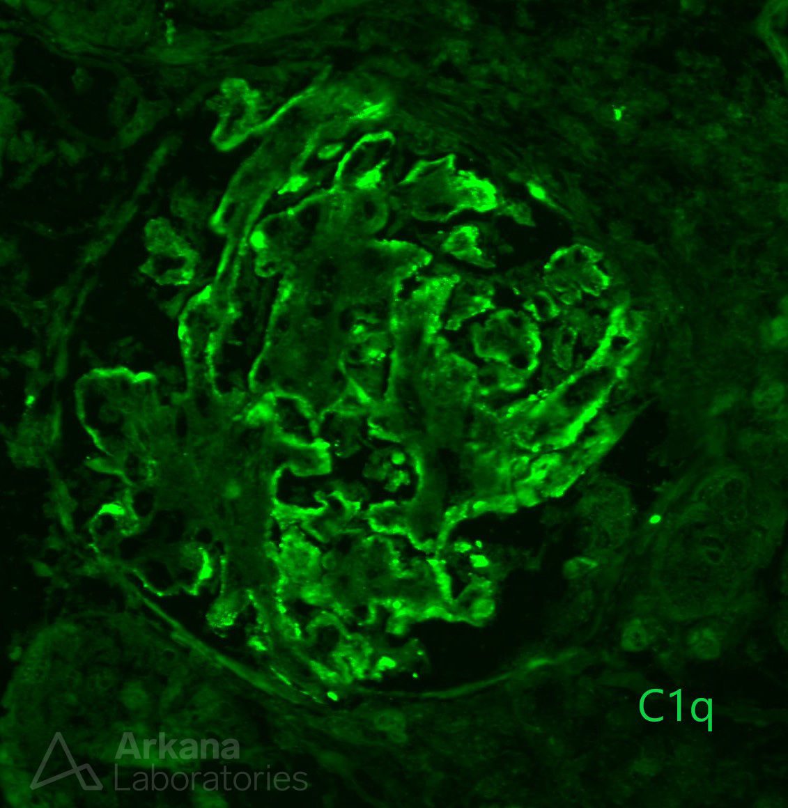 Hepatic Glomerulosclerosis