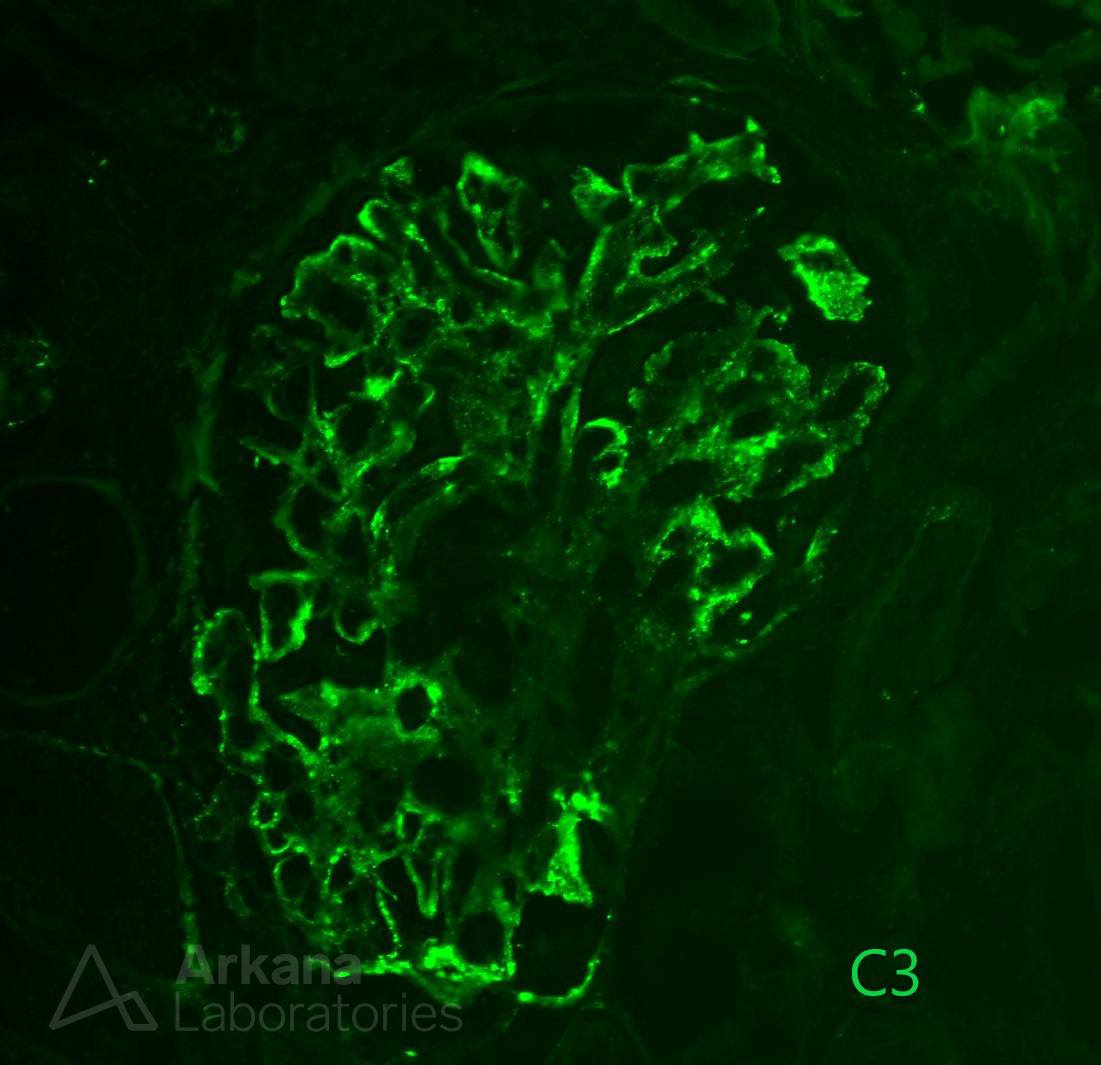 Hepatic Glomerulosclerosis