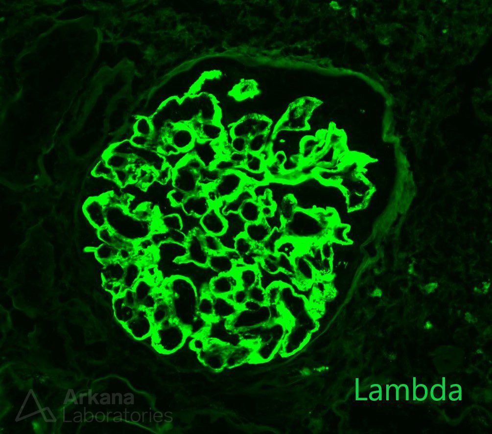 Hepatic Glomerulosclerosis