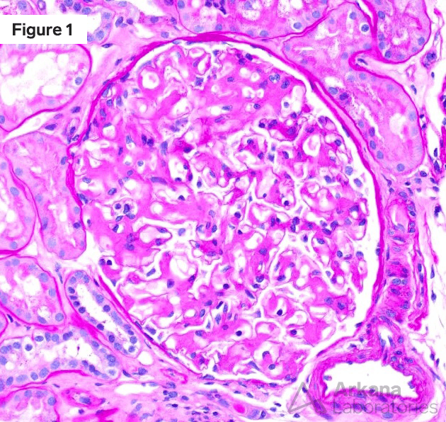 AL amyloidosis PAS