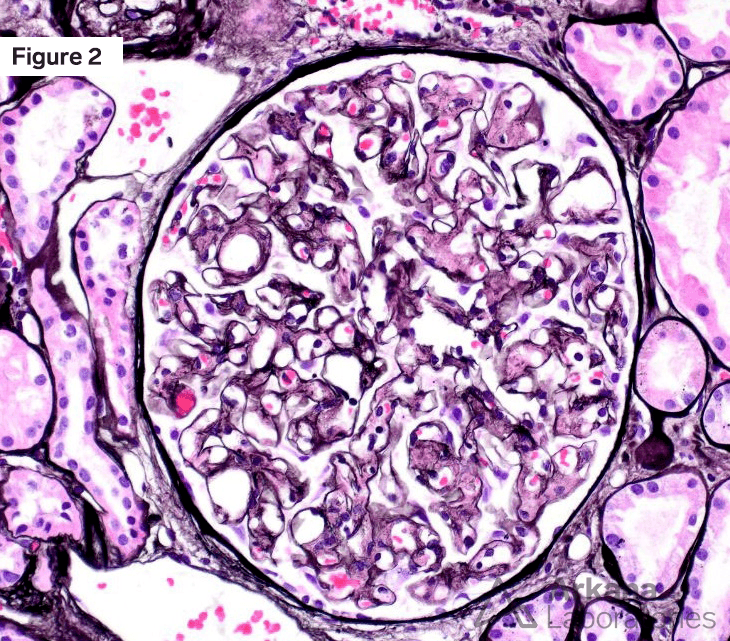 AL amyloidosis Silver Stain