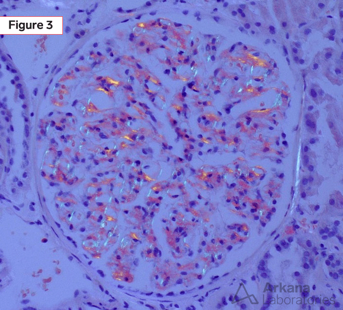 AL amyloidosis Congo Red