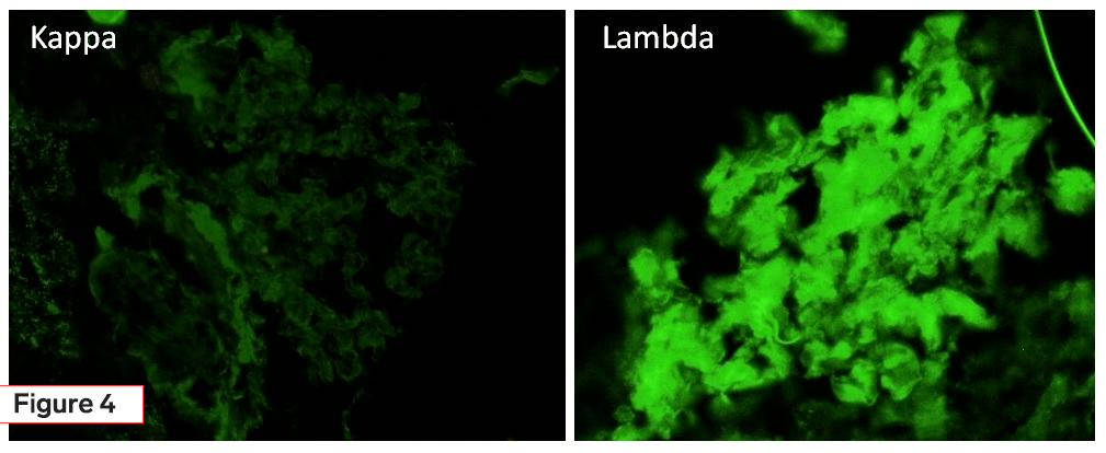 AL amyloidosis