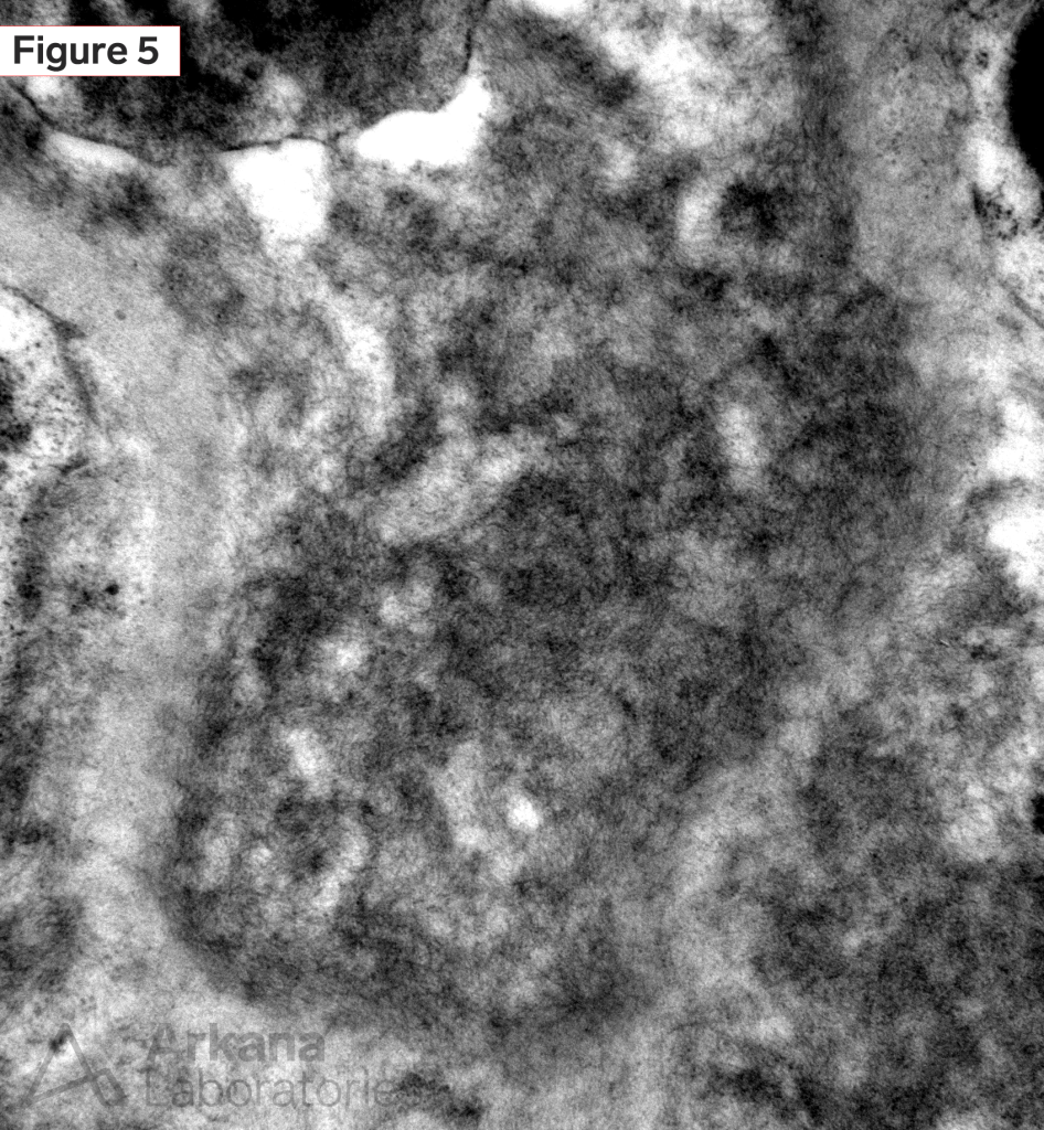 AL amyloidosis