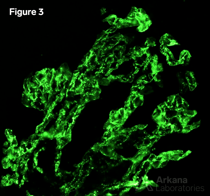 Post-Streptococcal Acute Glomerulonephritis (PSAGN)