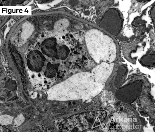 Post-Streptococcal Acute Glomerulonephritis (PSAGN)