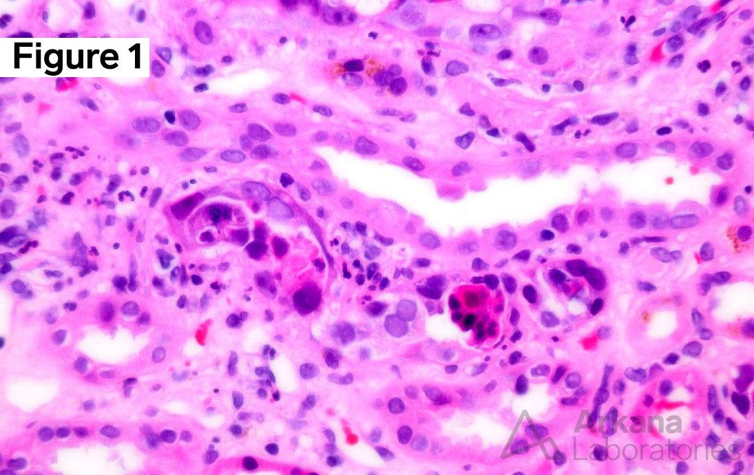 polyomavirus nephropathy