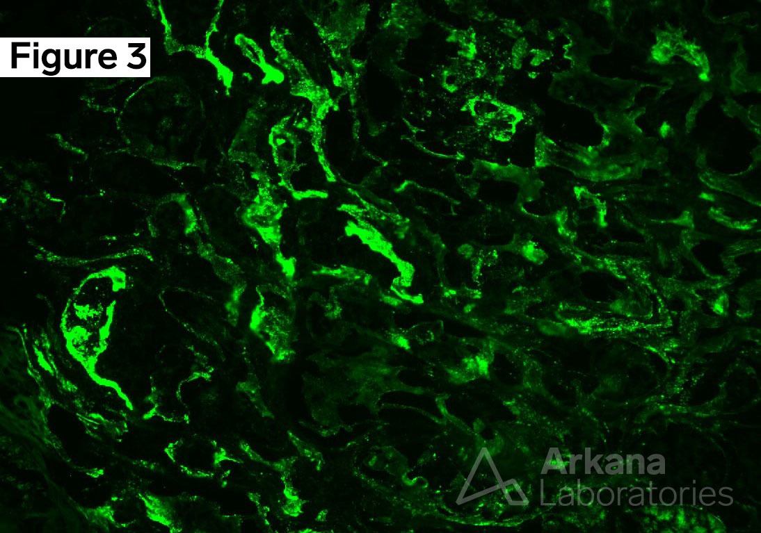 polyomavirus nephropathy PVN