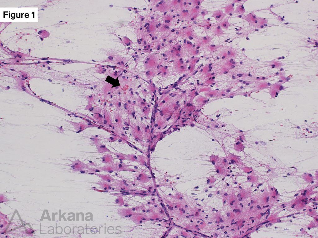 Astrocytic neoplasm