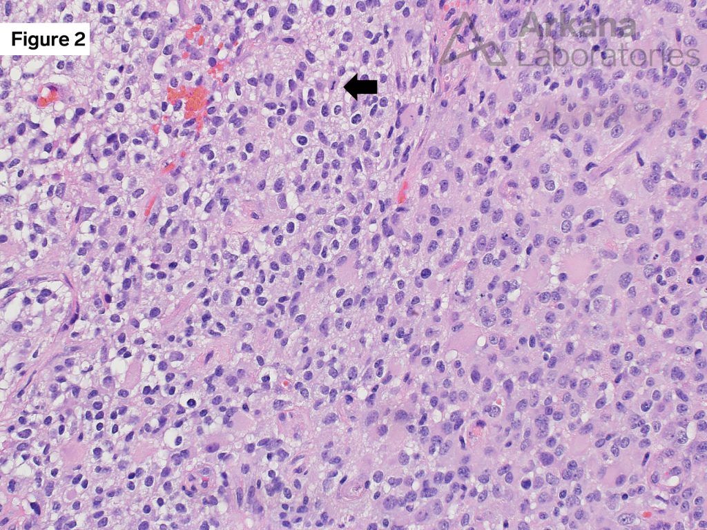 Astrocytic neoplasm