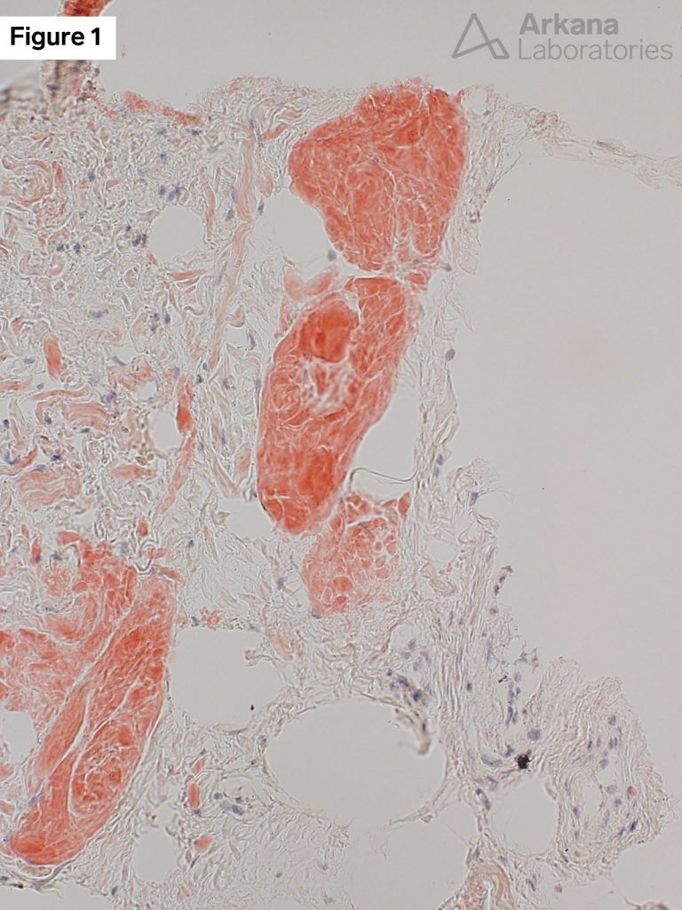 Amyloid C5b-9