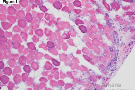 MxA Figure 1: Hematoxylin and eosin frozen section 200x original magnification