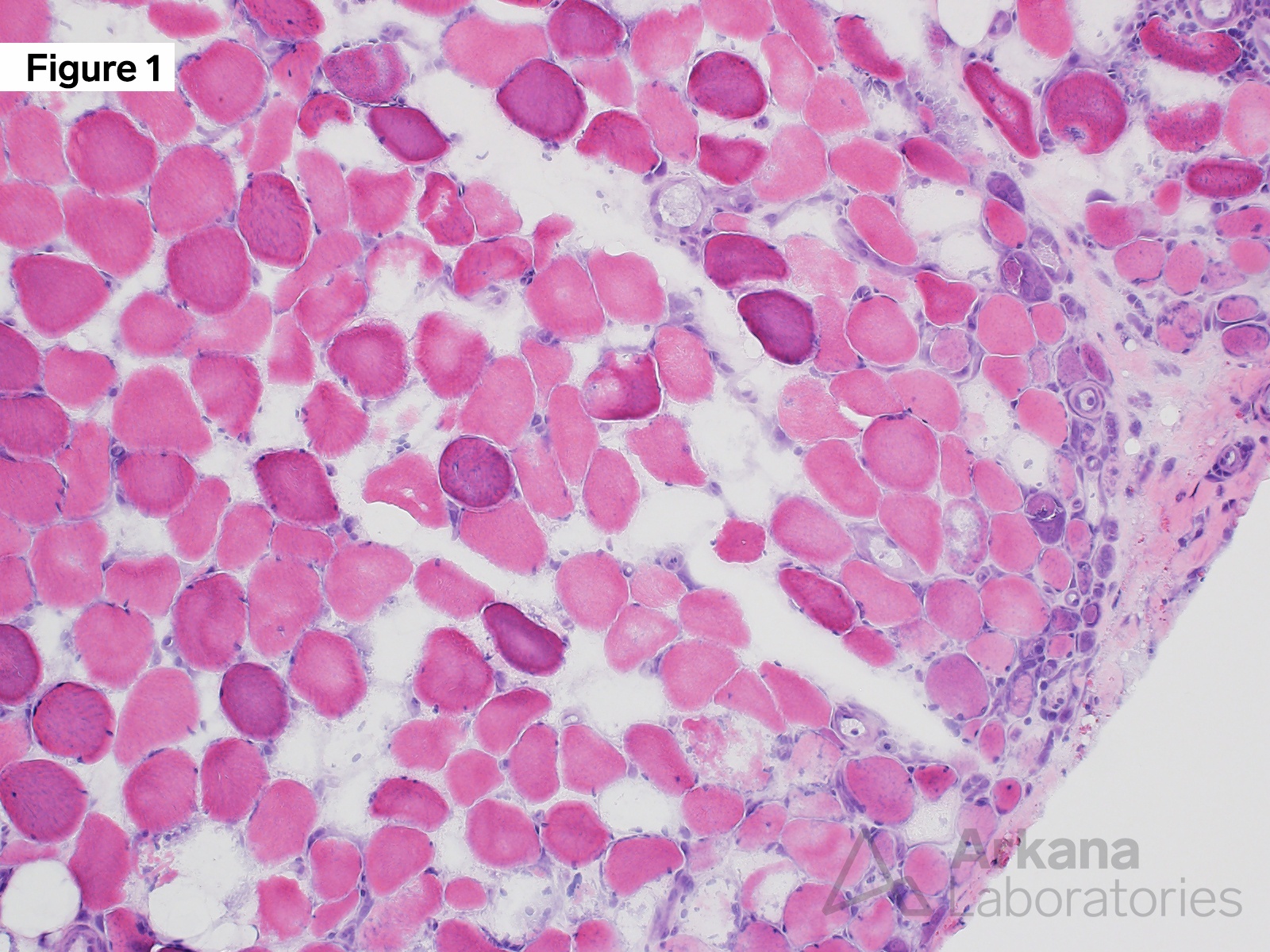 MxA Figure 1: Hematoxylin and eosin frozen section 200x original magnification